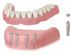 Implant-Supported Denture