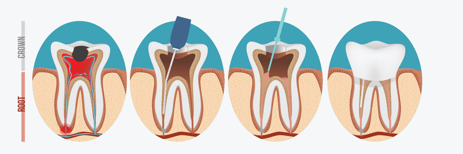 Endodontics - Kay Dental Care, Schomberg Dentist